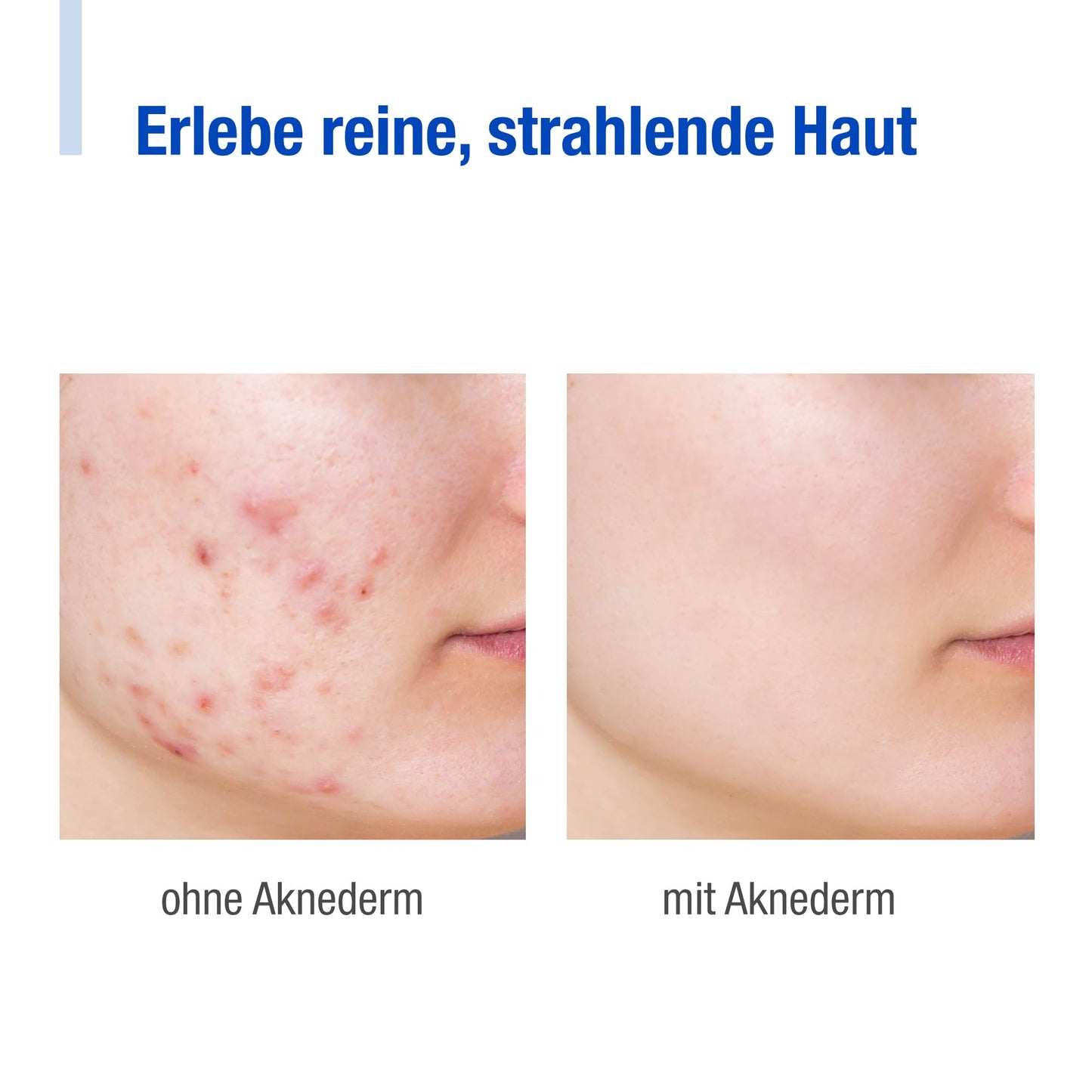aknederm Premium Set intense for normal skin - set with tincture/cleansing foam/lotion/cream intense & cleansing pads - natural skincare set - ideal for acne treatment 230ml